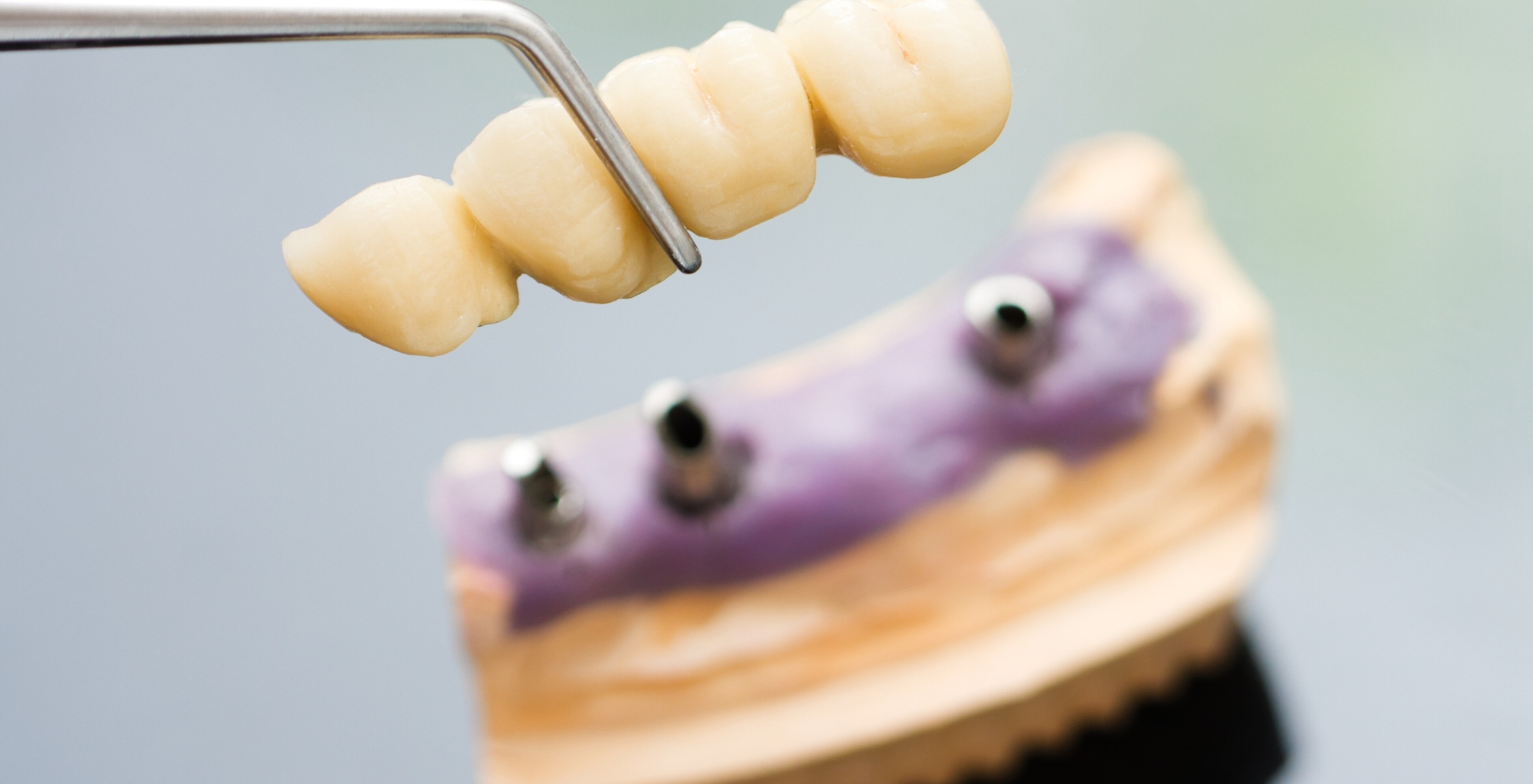Dental Crowns and Bridges