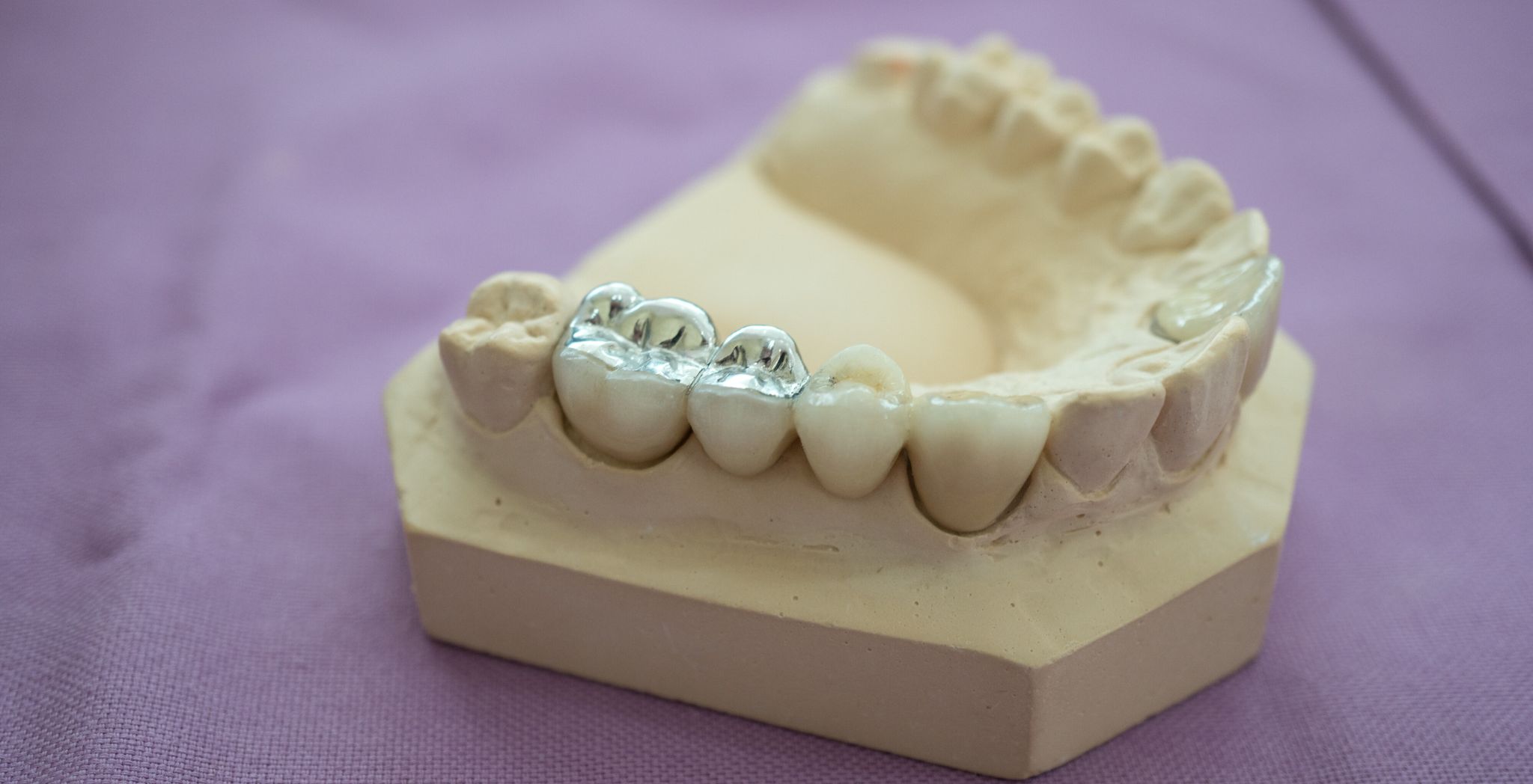 Tooth filling, Dental filling, Cavity filling, Tooth cavity treatment, Composite tooth filling, Amalgam tooth filling, Tooth decay restoration, Tooth filling procedure, Dental restoration for cavities, Cosmetic tooth filling