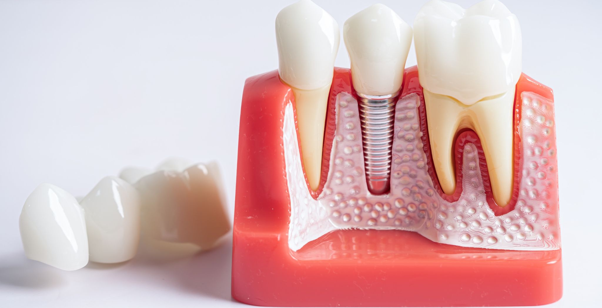 Before root canal treatment, After root canal procedure, Root canal treatment results, Root canal before and after images, Dental root canal procedure, Tooth pain before root canal, Root canal recovery, Healing after root canal, Root canal treatment benefits, Tooth restoration after root canal, Endodontic procedure before and after, Improving tooth function with root canal, Before root canal symptoms, After root canal appearance