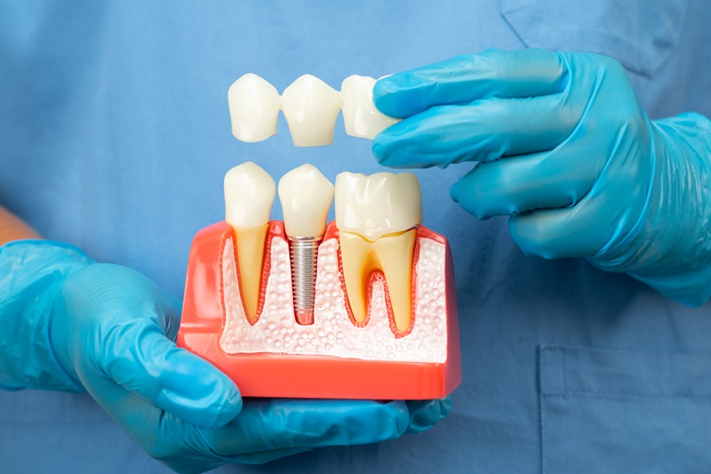Asian dentist holding dental implant, crowns and bridges
