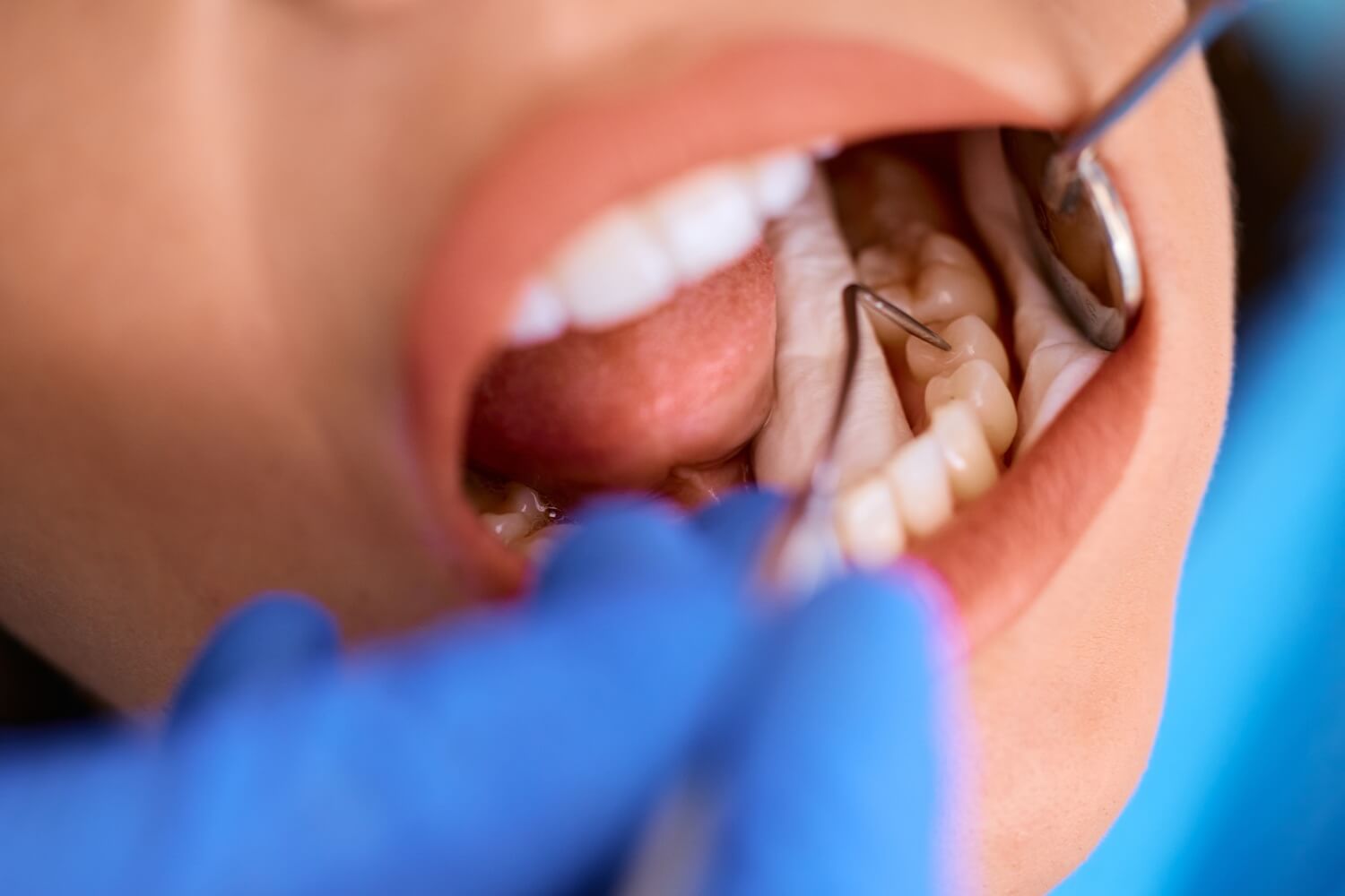 a female patient having dental fillings