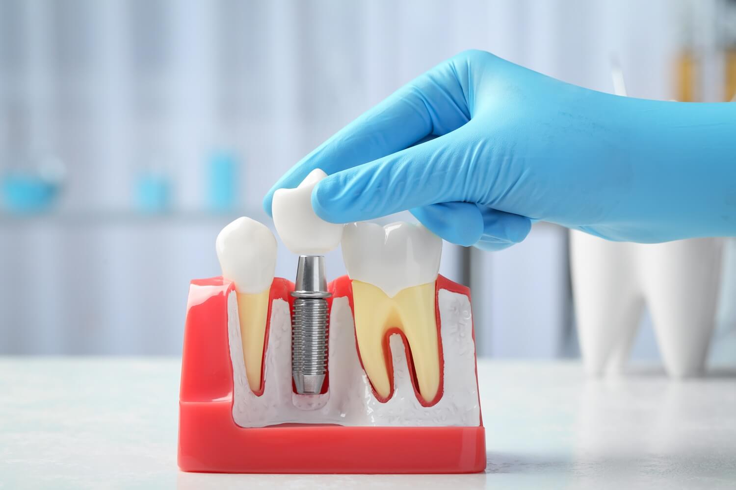 dentist putting dental implant model