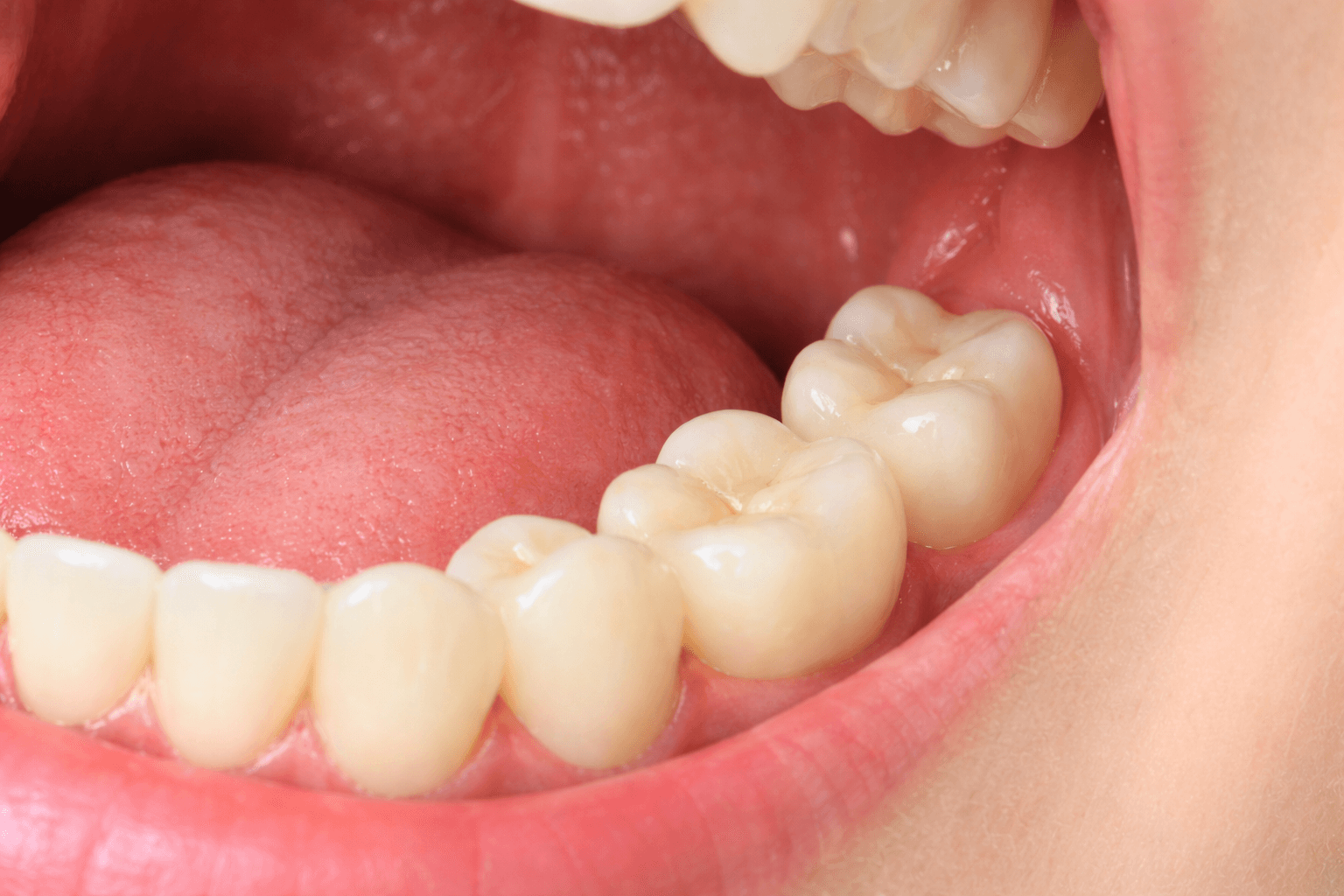 mouth showing wisdom tooth