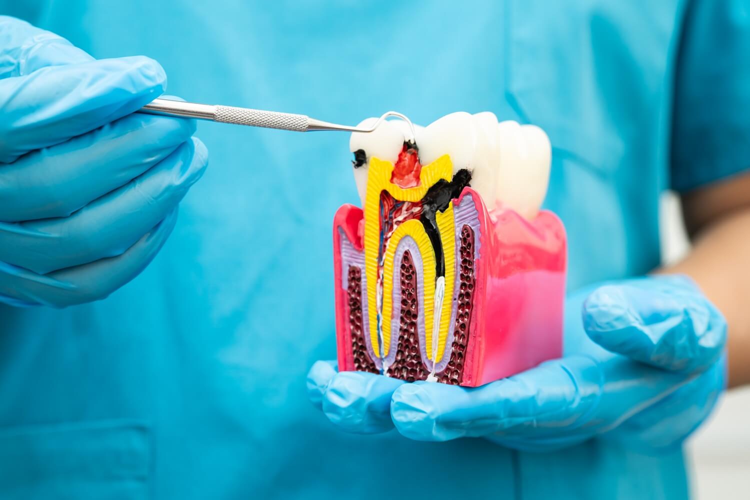 a dentist showing a root canal sample