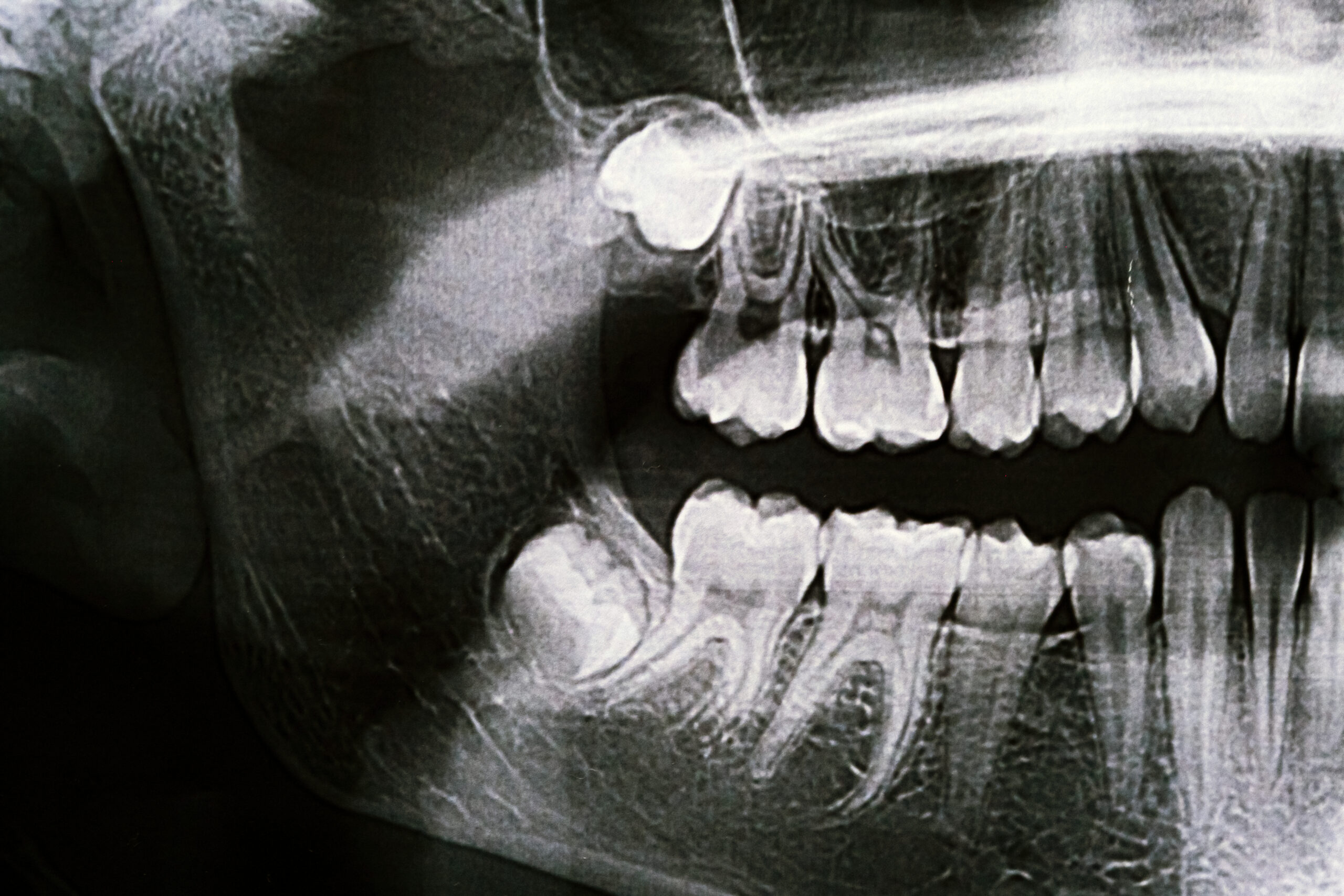 Dental X-ray showing wisdom teeth coming through, with a lower wisdom tooth angled against the neighbouring molar