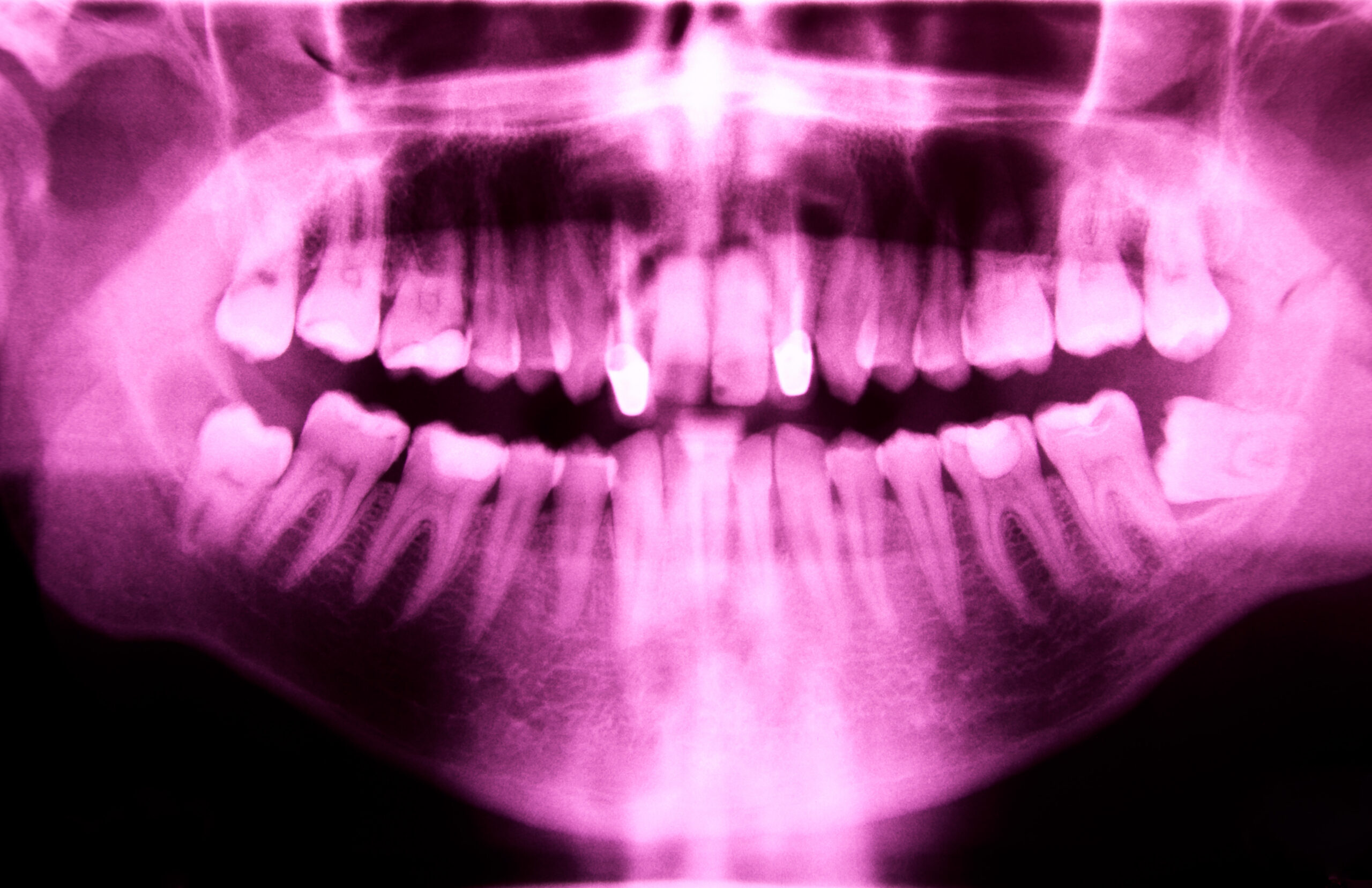 Panoramic dental x-ray showing impacted lower wisdom teeth that may need removal and stitches
